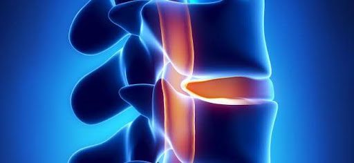 spinal disk pain