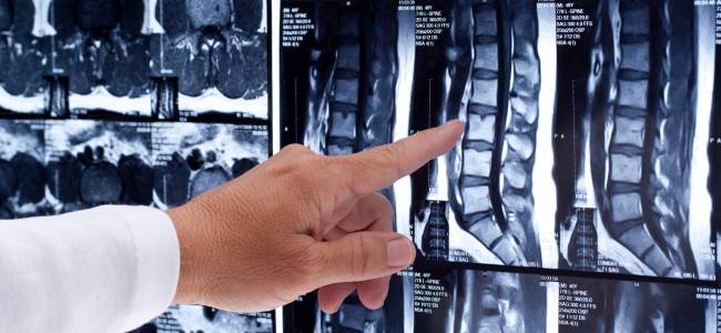 hand pointing to spine xray